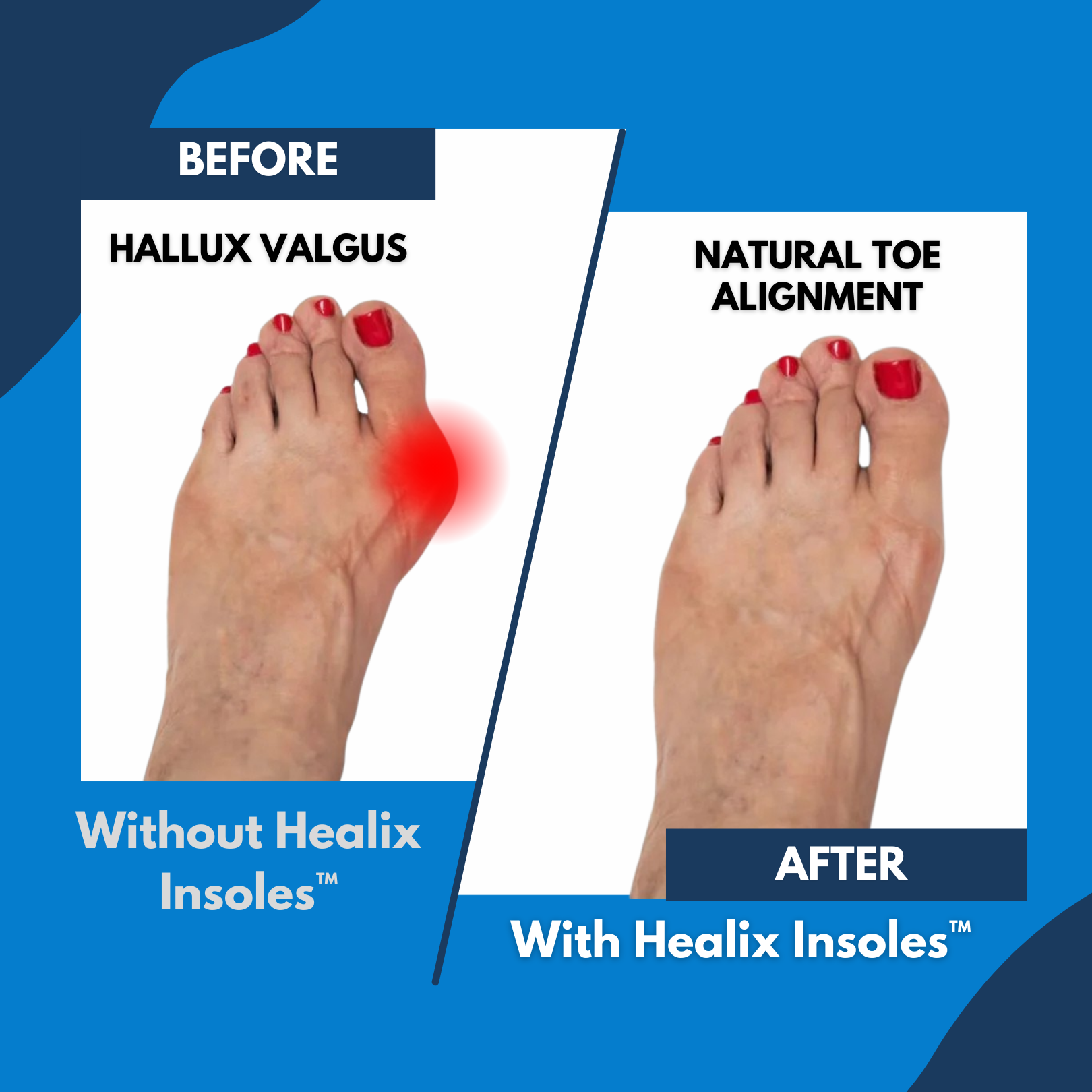 Healix Insoles: Relieve Pain & Protect Your Joints